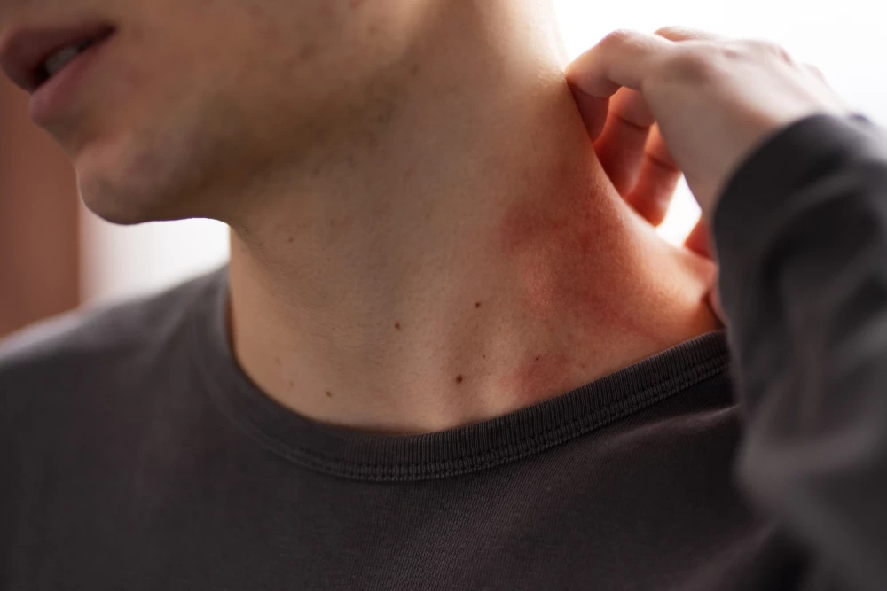 antifungal cream