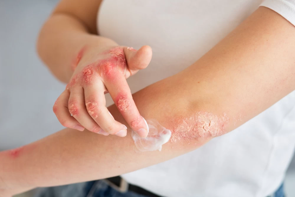 Best Antifungal Cream Suppliers Across India