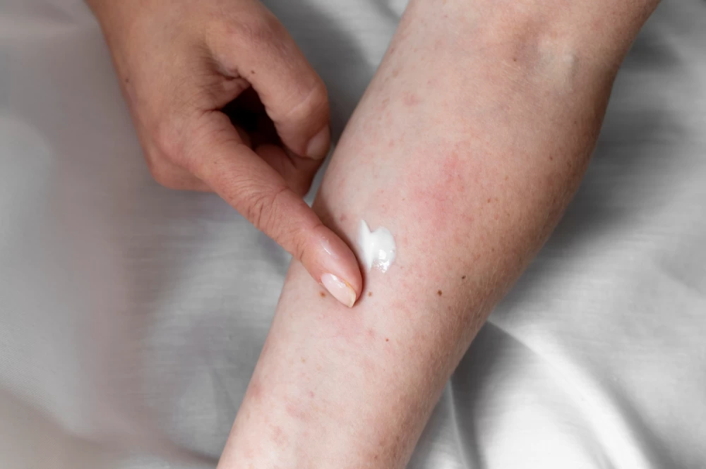 antifungal cream distributors