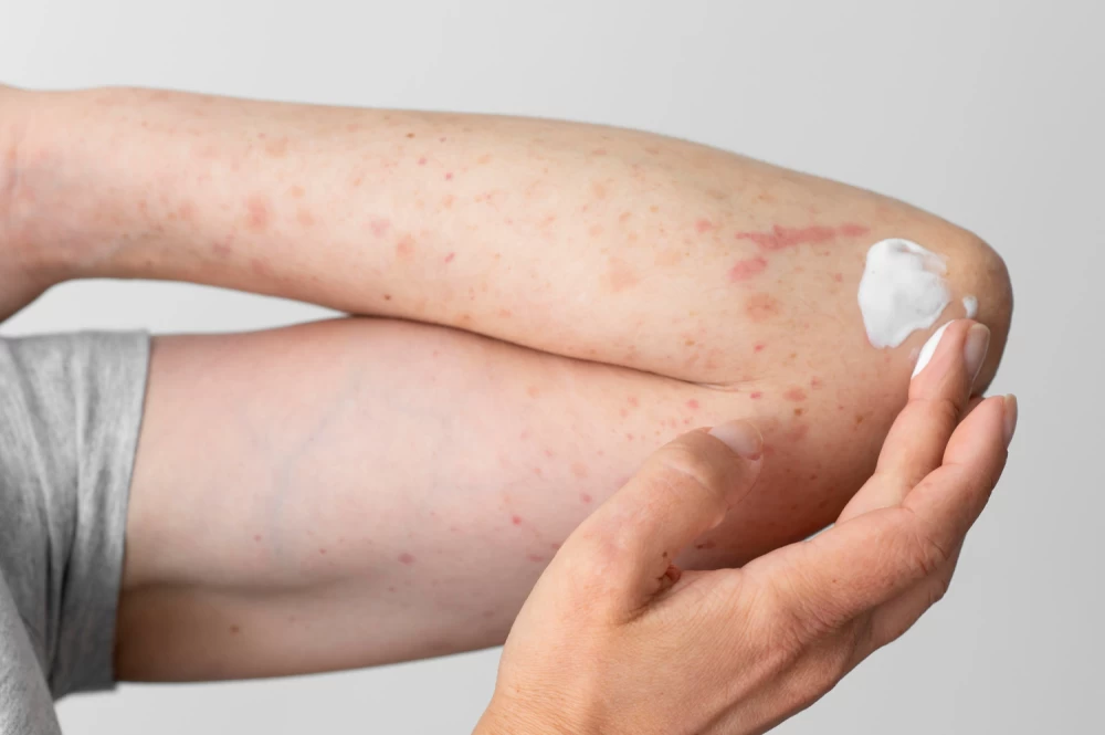antifungal cream pcd pharma company