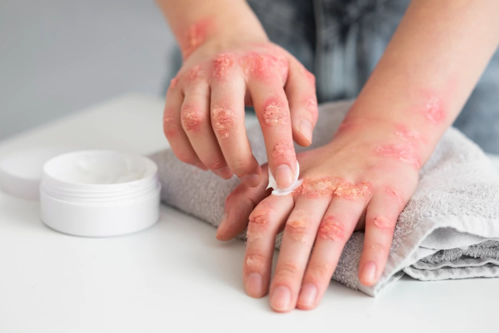 antifungal cream pcd pharma companies