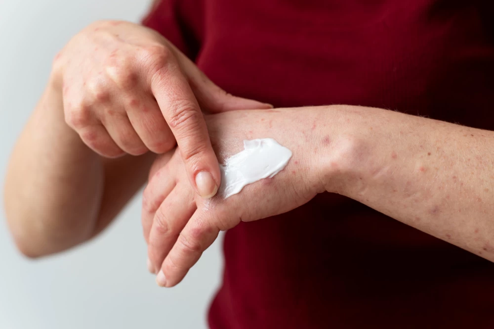 antifungal cream franchise company